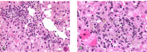 H& E (10X) image demonstrating increased mononuclear cell inflammation in left upper quadrant with apoptotic hepatocyte (arrow). 3B. (40X) demonstrates a paucity of hepatocytes indicative of pericentral collapse with numerous lipofuschin-laden Kupffer cells (arrow).