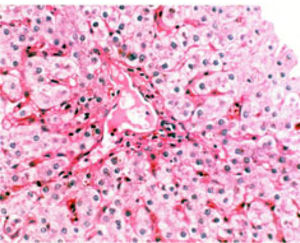 High power field of H&E stain of liver tissue from the first biopsy shows disappearance of interlobular bile ducts with mild portal inflammation with predominant polymorphonuclear cells.