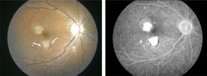Photograph of the right fundus at the initial exam. In addition to the cotton wool spots, there are two white lesions in the macula. The inferior lesion has an associated crescent of subretinal hemorrhage (arrows). Fluorescein angiography shows leakage from the lesion in the right eye.