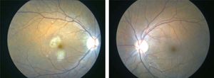 Right and left fundus photographs at 3 weeks shows less hemorrhage and resolving cotton wool spots.