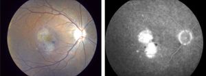 Right fundus photography and fluorescein angiography at 8 weeks showing new hemorrhage around the neovascular membrane and leakage.