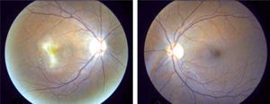 Right and left fundus photographs at 18 weeks showing involution of the neovascular membranes, no further hemorrhage, and complete resolution of the cotton wool spots.