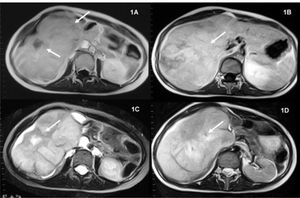 Magnetic resonance imaging (MRI) images. MRI showed on unenhanced T1-weigthed transverse image a right hepatic lobe mass (arrows) that is hypointense. A. Enhanced T1-weigthed transverse image of the liver obtained 3 minutes after administration of gadolinium shows a slight, unhomogeneous contrast material uptake. B. Unenhanced T1-weigthed fat-suppressed transverse image reveals areas of hyperintensity indicating hemorrhage. C. On the T2-weighted transverse image the lesion is slightly hyperintense in comparison to remaining liver parenchyma D.