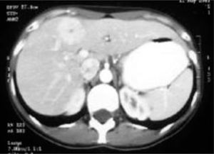 Abdomen CT that shows the presence of focal nodular hyperplasia of the liver with central scar.