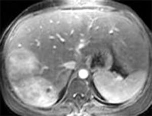 Abdomen CT that shows the presence of an adenoma in the right hepatic lobule.