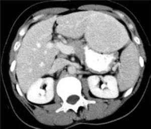 Abdomen CT that shows the presence of disseminated liver focal nodular hyperplasia.