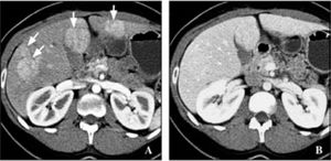 32 years-old woman with focal nodular hyperplasia. A and B. Axial image in arterial phase reveals multiple hypervascular lesions in both lobes of liver (arrows, A) that become isodense to liver parenchyma in portal venous phase (B).