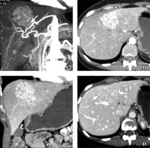 35 years old woman with focal nodular hyperplasia. A. Coronal maximum intensity projection image in arterial phase shows small branch from replaced left hepatic artery (arrow) supplying dome lesion. B and C. Axial (B) and coronal (C) multiplanar reconstruction in arterial phase show reticular patern of enhancement typical of focal nodular hyperplasia. D. Reticular pattern in less conspicuous in portal venous phase (arrows).