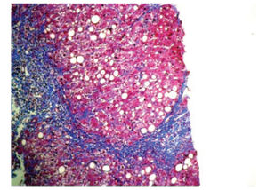 Liver biopsy (Masson trichrome, 200X) showing advanced fibrosis and macrovacuolar steatosis.