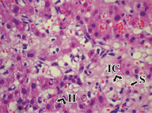 Liver biopsy (a) HE, 400X;