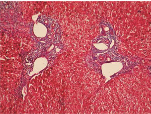 Masson’s trichromic stain shows fibrosis and widening of the portal tracts (Metavir F1).