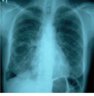 Chest radiograph at time of referral.