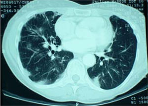 CT scan of chest showing airspace shadowing in keeping with pneumonitis.