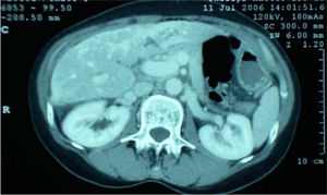 CT scan of abdomen showing low attenuation patches in the liver parenchyma.