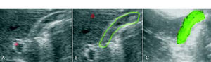3-dimensional ultrasonography. Representative 2-dimensional ultrasonographical image (A), manual outlining, (B) and computer calculated 3-dimensional reconstruction, (C) of the gallbladder are shown.