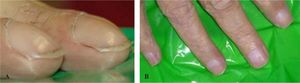 Gross clubbing in patient with alcohol-related liver cirrhosis (Koulaouzidis A, Said E. Clubbing in a patient with liver disease. Saudi Med J 2007 Mar; 28: 481-2, with permission). B. (ammendum) - Terry’s nails or half-and-half nails/associated with hypoalbuminaemia in patient with cirrhosis.