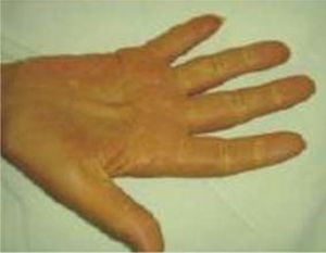 Dupuytren’s contracture (Macias-Rodriguez RU, Torre-Delgadillo A. Xanthelasmas and xanthomatas striatum palmare in primary biliary cirrhosis. Ann Hepatol. 2006 Jan-Mar; 5: 49, with permission).