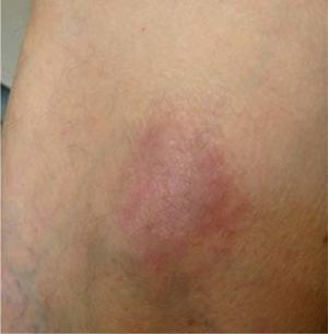 Leucocytoclastic vasculitis-discrete red/purple plaque with fine scales on its surface.