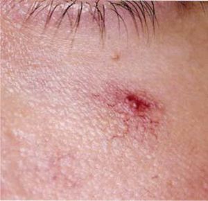 Close up view of the central arteriole (punctum) of a spider naevus (from Color Atlas ’ Synopsis of Clinical Dermatology, 4the, Fitzpatrick et al., with permission).