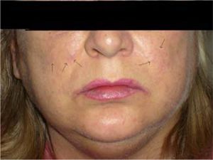 Fine “paper-money” skin appearance of cheeks and nasolabial folds, hypertrichosis and bilateral parotid enlargement in patient with alcohol-related liver disease.