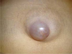 Umbilical hernia in patient with gross ascites.