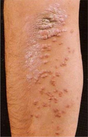 Papular eruptive xanthomas-multiple, discrete, papules becoming confluent at the level of elbow (from Color Atlas & Synopsis of Clinical Dermatology, 4the, Fitzpatrick et al., with permission).