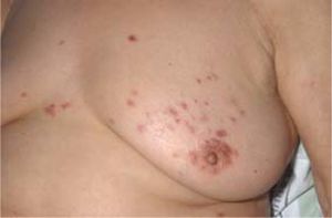 Pustular vaculitis - discrete, red papules and pustules in a patient with primary biliary cirrhosis (Koulaouzidis et al., from Annals of Hepatology 2006; 5(3), with permission).