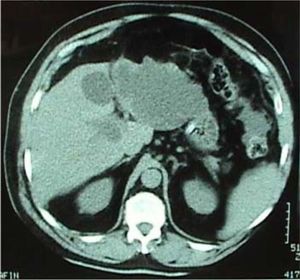 Computerized tomographic scan demonstrates a huge cyst with irregular borders, occupying the left liver lobe.