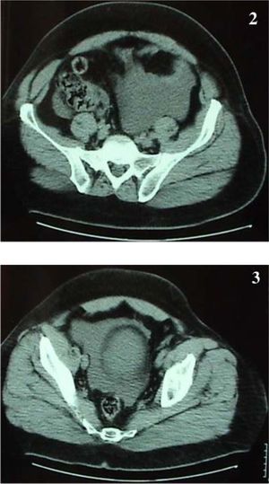Computerized tomographic scan demonstrates the presence of free intraperitoneal fluid, especially in the lower abdomen.