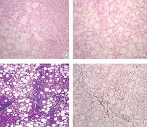 Histopatological presentation of NASH. a: Macrovesicular steatosis grade 2, ballooned hepatocytes grade 1 and a moderate mononuclear infiltrate. NASH 1 (Hematoxylin and eosin stain of liver, magnification × 100). b: Necrotic inflammation in the NASH 2 group, with more marked ballooned hepatocytes and a mild mononuclear infiltrate, without fibrosis. (Hematoxylin and eosin stain of liver, magnification × 100). c: Histologic features of fibrosis in nonalcoholic steatohepatitis (NASH 3 group), demonstrating macrovesicular steatosis and fibrosis, most prominent in zone 3 near the central vein of the hepatic lobule. (Trichrome stain of liver, magnification × 100). d: Typically early fibrosis is pericellular and perisinusoidal, giving the appearance of «chickenwire.», also NASH 3 (Reticulin stain of liver, magnification × 100).
