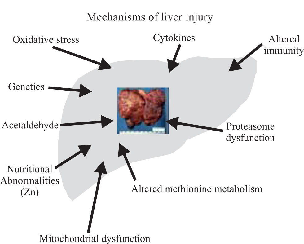 Treatment of alcoholic liver disease | Annals of Hepatology
