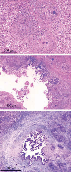 Explanted liver from case 2. 3a. Several non-caseating granulomas with multinucleated giant cells in a hepatic lobule. H+E; Original magnification = x40. 3b. Large intrahepatic bile duct. The ductal submucosa contains a dense inflammatory infiltrate, and several granulomas with multinucleated giant cells. Most of the ductal mucosa has been destroyed by the inflammatory process. H+E; Original magnification = x20. 3c. Intrahepatic bile duct. The submucosa contains a dense inflammatory infiltrate and several non-caseating granulomas. The ductal mucosa has been damaged at several points. The duct is surrounded by dense fibrous connective tissue.