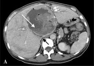 Axial computed tomography demonstrating necrotic/infected portion of large liver mass with fluid level (long white arrow), junction of compressed left hepatic vein and inferior vena cava (black arrow), and compressed vessels that are likely portal (double white arrows).