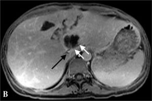 Gadopentetate dimeglumine (contrast) enhanced 2D gradient T1 magnetic resonance image demonstrating large liver tumor, thrombosed inferior vena cava (black arrow), and stenotic or compressed left hepatic vein.