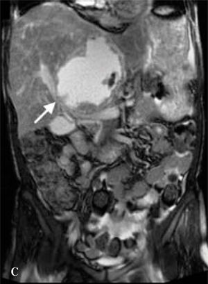 Contrast-enhanced steady-state free-precession (combination of T1 and T2) magnetic resonance image demonstrating large liver tumor and compressed right portal vein (white arrow).