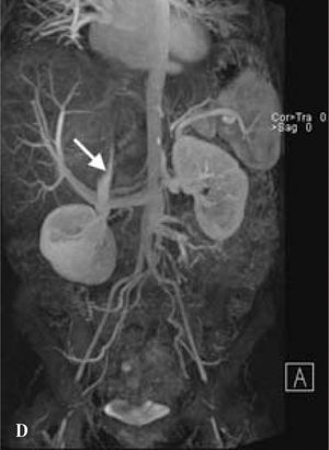 Magnetic resonance angiography demonstrating thrombosed inferior vena cava (white arrow) and non-visualization of the left portal system.