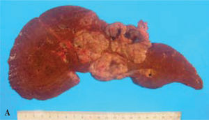 Low-power microscopic view of papillary tumor filling a bile duct lumen. The lumen is lined by both flattened, atrophic biliary eipthilum (white arrow) and by tumor cells (black arrow); inset showing high-power view of characteristic oncocytic cells with abundant, granular, eosinophilic cytoplasm.