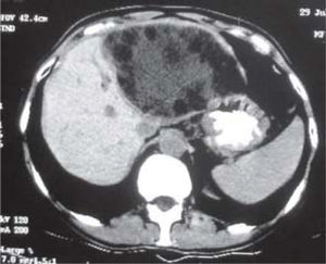 Contrast enhanced computed tomography scan showing a giant hydatid cyst occupying almost the entire left liver lobe. It contains inhomogeneous fluid and several daughter cysts.
