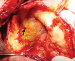 Intraoperative photo showing the giant hydatid cyst before management of the residual cavity. Note the site of biliary communication (arrow).
