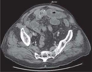 CT image showing ectopic gallstone in the small bowel.