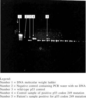 Electrophoretic pattern of enzyme digestion of PCR product seen on agarose gel.