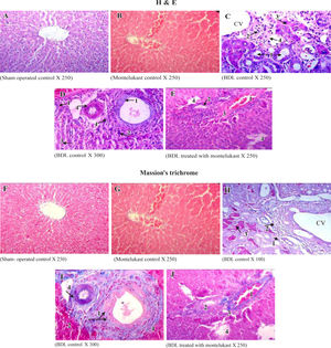 Histological sections of liver tissue stained with H&E (upper panels, A-B) or Masson’s trichrome (lower panels, F-J). Representative photomicrographs of sham-operated control (A,F) showing normal liver parenchyma with hepatocytes and sinusoids and normal hepatic architecture. sham-operated control treated with montelukast (B,G) showed normal hepatic architecture with mild congestion1 and edema2. BDL rats (C,D,H,I) showed severe bile duct proliferation,1 leukocytes around the portal traid and the CV,2 necrosis of hepatocytes3 and fibrous tissue proliferation.4 BDL rats treated with montelukast (E, J) showed mild congestion,1 few bile duct proliferations with dege-neration,2 mild degree of periportal fibrosis3 and moderate focal necrosis.4