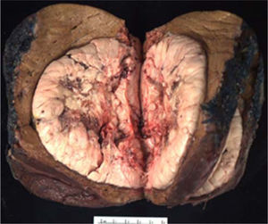 Photograph of resected hepatocellular carcinoma with grossly unremarkable surrounding liver.