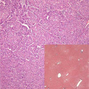 Photomicrograph of moderately differentiated hepa-tocellular carcinoma with exaggerated trabecular and solid patterns (Hematoxylin-eosin 100x). Inlay: non-tumorous liver demonstrating mild macrovesicular steatosis, but otherwise no features of chronic hepatitis, fibrosis, or other significant change (Trichrome 4x).