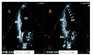 Transthoracic echocardiography study, 4 chamber view, showing right heart opacification with contrast saline bubbles (A), and the presence of contrast in the left heart (B, arrows) evident > 5 cardiac cycles of right heart opacification, compatible with the presence of a pulmonary arteriovenous shunt.