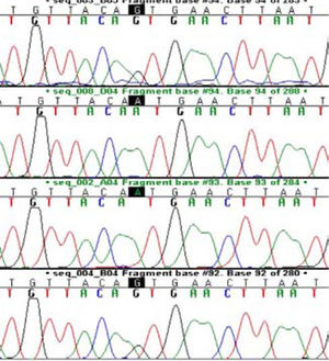 Sequence analysis of NAFLD patients: Mutation at N34S is seen.