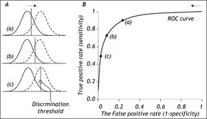 The relation between the discrimination threshold (A) and the position on the receiver operating characteristic (ROC) curve (B). The ROC curve is a graphical plot of the true positive rate (sensitivity) as a function of the false positive rate (1-specificity) for a diagnostic test as its discrimination threshold is varied through the whole range. By moving the discrimination threshold from left to right, the points on the ROC curve are obtained from right to left. The figure shows the correspondence between three positions of the discrimination threshold (A) and the three corresponding points on the ROC curve (B).