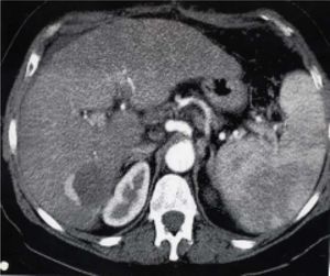 Control CT after PEI treatment showing a viable tumor.