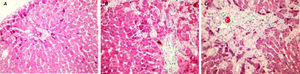 A sham-operated group rat liver section with normal finding (HE, original magnification ×40). (B) A bile duct ligation (BDL) group liver slide with portal fibrosis and fibrous septa, (Trichrome-stained original magnification ×40). (C) A BDL+peginterferon group liver slide with cellular loss and portal-portal fibrous septa connecting portal areas to each others and lobule centers (Trichrome-stained original magnification ×40). Peginterferon-alpha 2b (50 μg/kg) or saline (1 mL/kg) were administered intraperitoneally every week for four weeks.