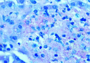 Intrahepatic foamy macrophages(H&E, 1000x)